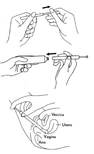 Disegno tecnico che mostra due mani che separano un dispositivo medico e un'illustrazione anatomica con l'inserimento in vagina, utero e vescica