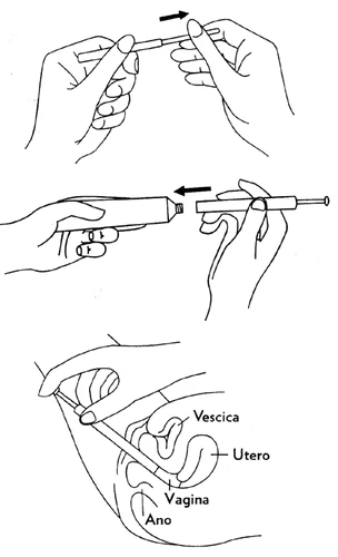Technical drawing showing two hands assembling a medical device and one hand inserting it into the vagina near the uterus and bladder