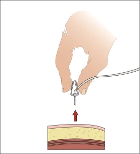 A hand holding a medical device with a downward-pointing needle above a cross-sectional representation of skin, with a red arrow