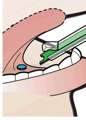 Medical illustration of a blue tablet being inserted into an open mouth between the upper and lower teeth