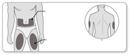 Diagramma del corpo umano che indica le zone di applicazione su addome, cosce e braccia tramite aree scure evidenziate con linee di riferimento
