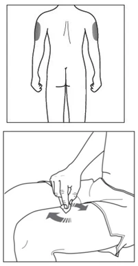 Schematic drawing of the back of a human body with highlighted areas on the arms and a close-up detail of a hand pinching the skin of the thigh