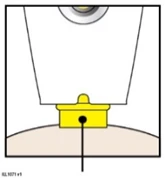 Medical illustration showing the lower part of a white device fitting into a yellow base above a light skin surface