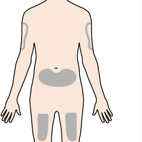 Human body diagram viewed from the back, with gray areas highlighted on arms, lower back, and thighs