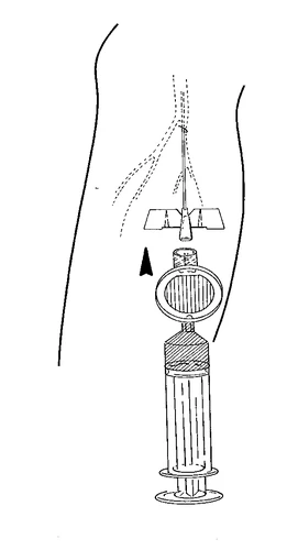 Disegno schematico che mostra l'inserimento di un ago in una gamba con una siringa posizionata verticalmente verso la pelle