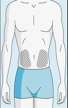 Schematic drawing of a male torso with two hatched areas on the lower abdomen indicating injection sites above blue underwear