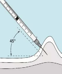 Diagram showing a syringe angled at 45 degrees to the skin surface for a