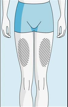 Medical diagram of a stylized human body with two hatched areas on the thighs indicating drug application sites