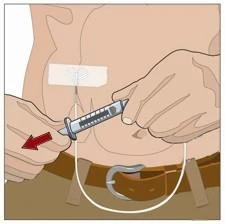 A hand holding a syringe to inject medication under the skin of the