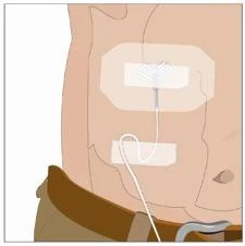 Medical illustration of a device with two adhesive electrodes applied on the torso and connected by a white wire on a human body