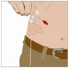A hand applying a medical device to the skin of the