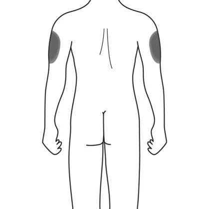 Schematic drawing of the human body viewed from the back, with two oval gray areas positioned on the upper outer part of both arms