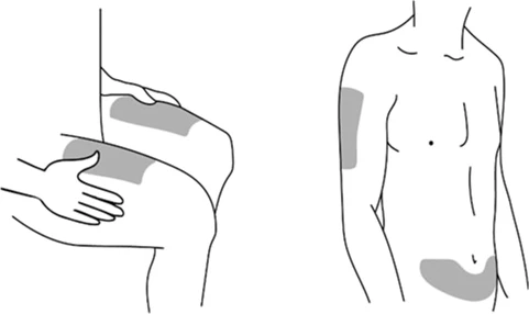 Dibujo esquemático de un hombre que muestra las áreas del cuerpo sombreadas para la