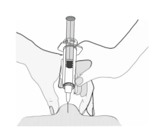 Black and white drawing showing two hands holding a syringe injecting liquid into the upper part of the nose
