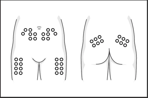 Human body diagram showing injection sites on the abdomen, thighs, and buttocks indicated by small black circles distributed across different areas