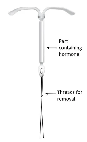 Diagramma di un dispositivo intrauterino a forma di T con sezione contenente l'ormone e fili sottili alla base per la rimozione