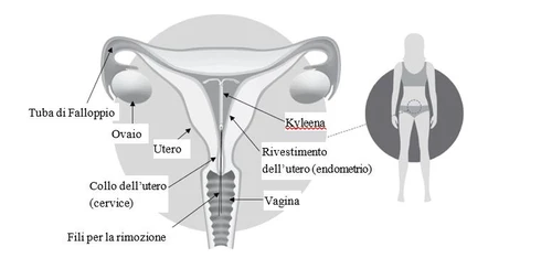 Diagramma anatomico femminile con sistema riproduttivo che mostra utero, ovaie, tube di Falloppio, vagina e il dispositivo Kyleena inserito