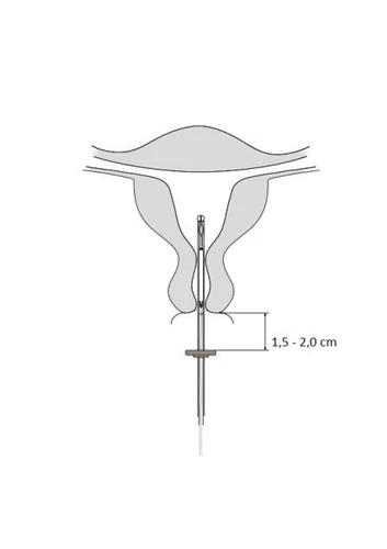 Diagramma medico dell'utero con un dispositivo inserito nella cavità uterina e un indicatore di profondità tra 1,5 e 2,0 cm