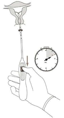 Illustrazione medica di una mano che impugna un dispositivo di inserimento in un utero con un cronometro che indica dieci secondi