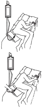 Disegno schematico di una persona a letto collegata a una sacca per infusione tramite un tubicino che scende verso la zona addominale