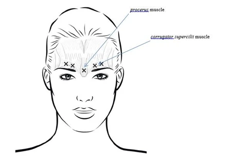 Disegno tecnico di un volto femminile con indicazioni dei punti di iniezione per il muscolo procerus e il muscolo corrugatore del sopracciglio