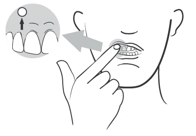 Disegno schematico di una mano che indica un dente con una macchia scura, ingrandimento del dente che mostra una lesione sulla superficie superiore