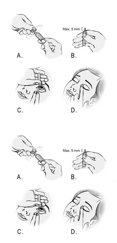 Medical diagram with four illustrated steps: hands handling an applicator, inserting the device near the eye