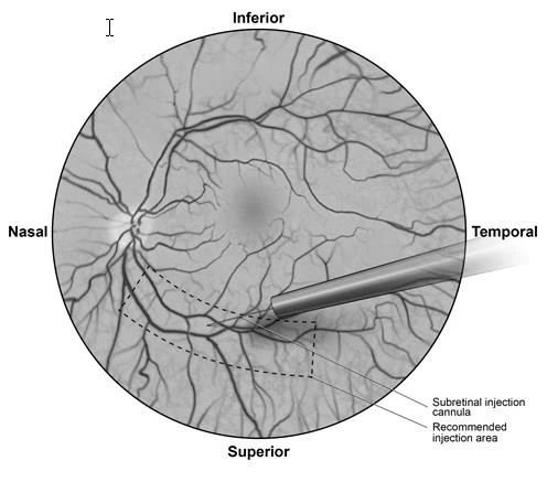 Medical diagram of the ocular fundus with a cannula for subretinal injection pointing towards the retina