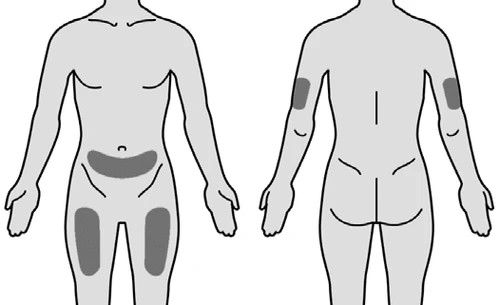 Diagramma anatomico di un corpo umano che mostra zone grigie per l'iniezione sull'addome, sulla parte superiore delle cosce e sui bicipiti