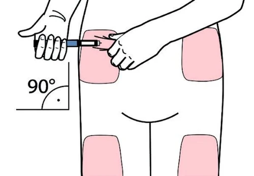 Dibujo esquemático de un cuerpo humano con cuatro zonas rosadas en los muslos y glúteos que muestra la
