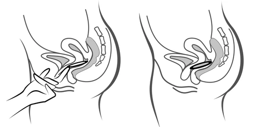 Diagramma medico che mostra due profili laterali del bacino femminile, con una mano che inserisce un applicatore nell'area vaginale