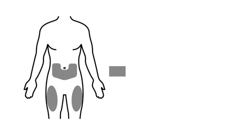 Schema stilizzato di un corpo umano con tre aree grigie che indicano i siti di iniezione sull'addome e sulle cosce destra e sinistra
