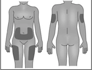 Diagramma medico che mostra due figure umane, una frontale e una posteriore, con aree scure evidenziate sull'addome, sulle cosce e sulle braccia