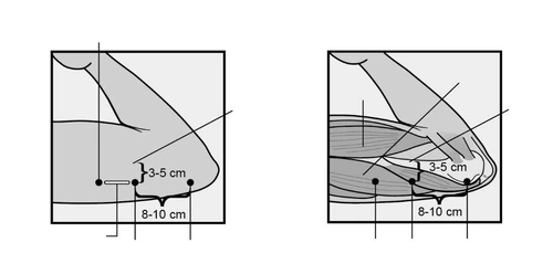 Due diagrammi medici mostrano le misurazioni per l'iniezione sulla coscia con distanze indicate di 3-5 cm e 8-10 cm rispetto alle articolazioni