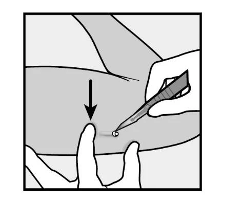 Disegno in bianco e nero che mostra una mano che tiene una siringa per iniettare un farmaco sulla pelle mentre un dito indica il punto di iniezione