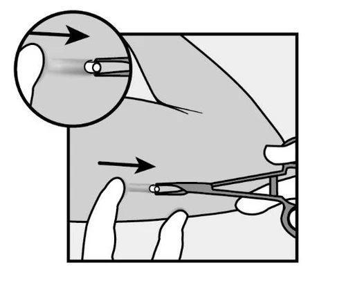 Diagramma medico che mostra l'inserimento di un dispositivo sottocutaneo nella pelle con un ingrandimento del dettaglio della punta dell'ago