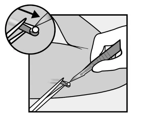Disegno tecnico che mostra una mano che tiene un dispositivo medico per l'iniezione sulla pelle con un ingrandimento del dettaglio dell'ago