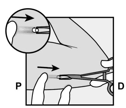 Diagramma medico che mostra l'inserimento di un dispositivo sottocutaneo nel braccio con frecce direzionali e dettaglio ingrandito dell'ago