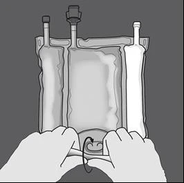 Two hands pressing the base of an infusion bag with three upper tubes to expel the