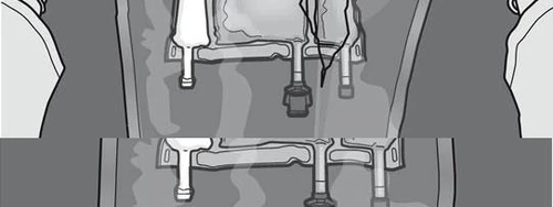 Black and white technical drawing showing a detailed view of a medical device with cylindrical components and attachment mechanisms