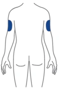 Schematic drawing of a person's torso and arms viewed from behind with two blue-highlighted areas on the upper part of both arms
