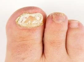 Close-up of a foot with the
