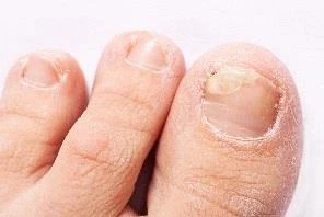 Close-up of three toes with the
