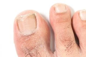 Detail of a toe with thickened, yellowed, and brittle nail, surrounded by red, scaly skin typical of a