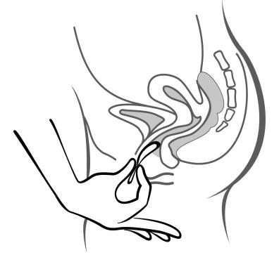 Schematic drawing showing a hand applying a medical device to the breast area for the