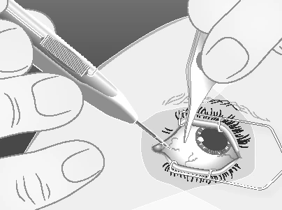 A surgeon uses a scalpel and forceps to perform surgery on a human eye with the eyelids held open