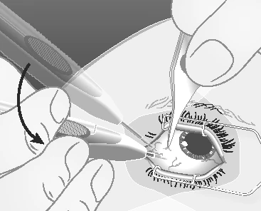Medical illustration showing hands using tweezers and an applicator to insert a device into the