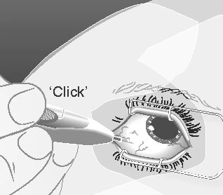 Medical illustration of a hand using a device for