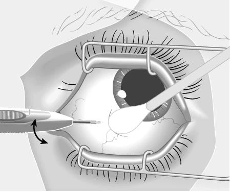 Medical illustration of an open eye with a retractor mirror and an applicator touching the ocular surface for treatment