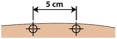 Diagram showing two black target points on a skin surface, spaced apart by an arrow labeled 5 cm